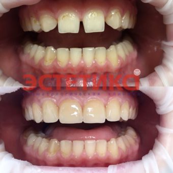 Протезирование зубов до и после