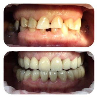 Протезирование зубов до и после