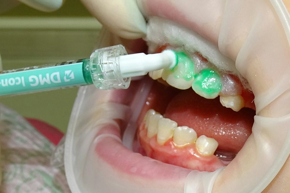 Лечение кариеса ICON Томск Новосибирская эндодонтия 46 зуба